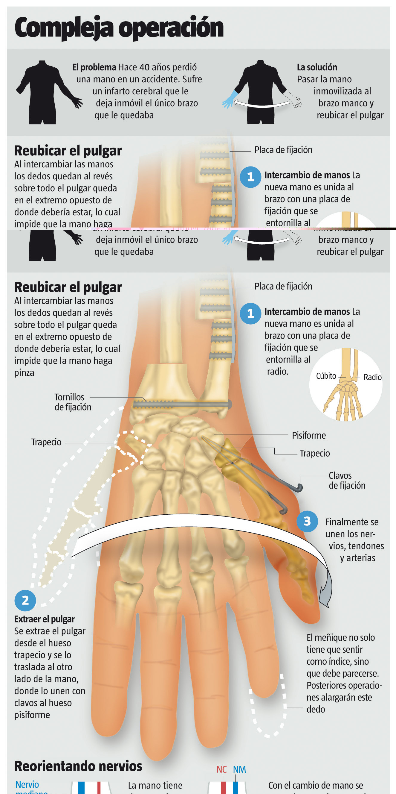 Infografías - Operación compleja: Trasplante de mano